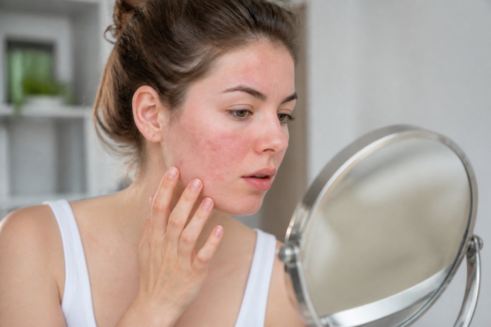 How to Treat Rosacea and Acne Together: A 2026 Routine