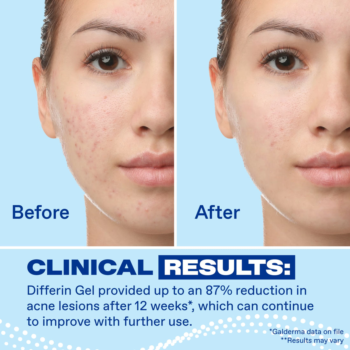 Adapalene 0.1% Retinoid Acne Treatment Gel, Fragrance-Free, 15g Tube - Prescription Strength for Effective Acne Clearance and Prevention